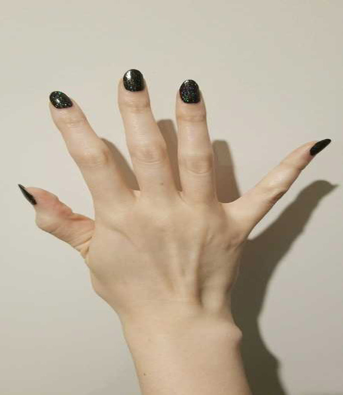 Diagnosis of Marfan Syndrome Marfan Trust